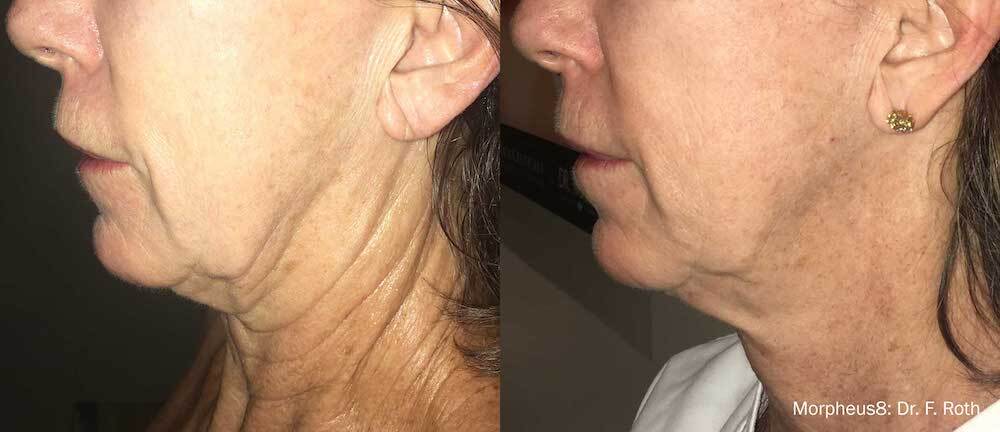 Morpheus8 Skin Treatments in Kansas City - Before 1