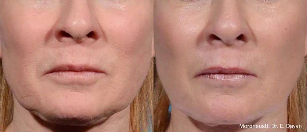 Morpheus8 Skin Treatments in Kansas City - Before 3