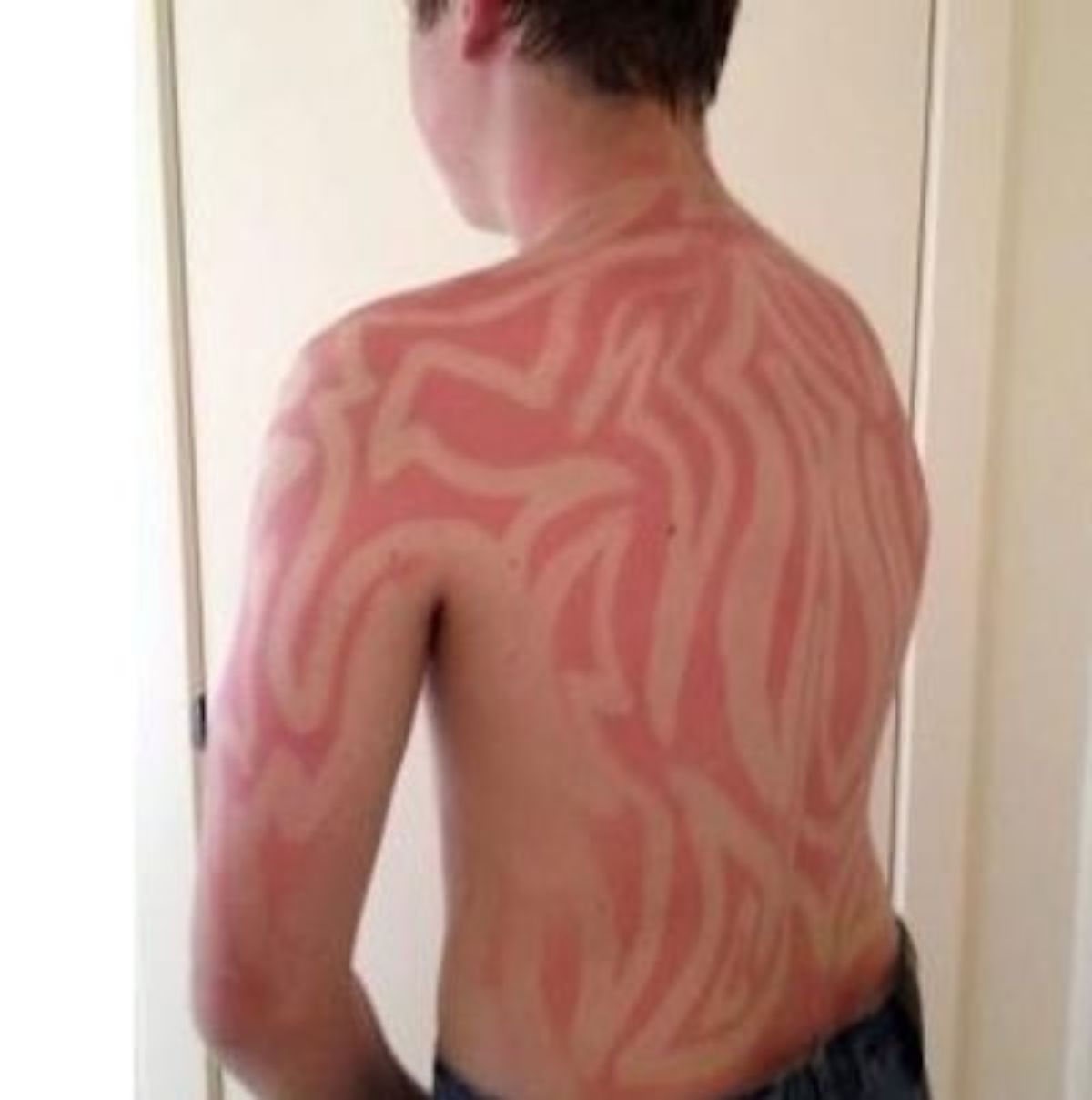 Sunburn art