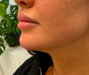 After Restylane Defyne in Chin