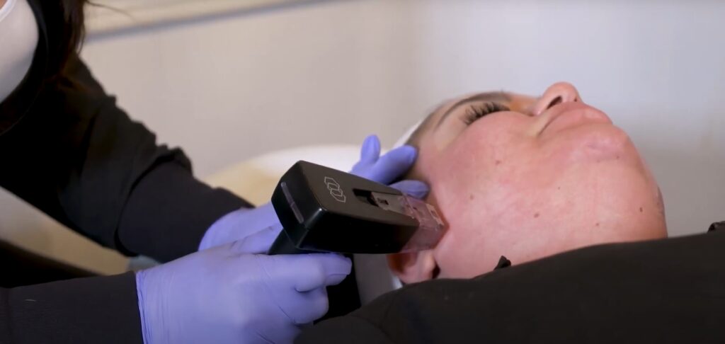 A patient undergoing a Morpheus8 treatment session with a handheld device applied to the skin.