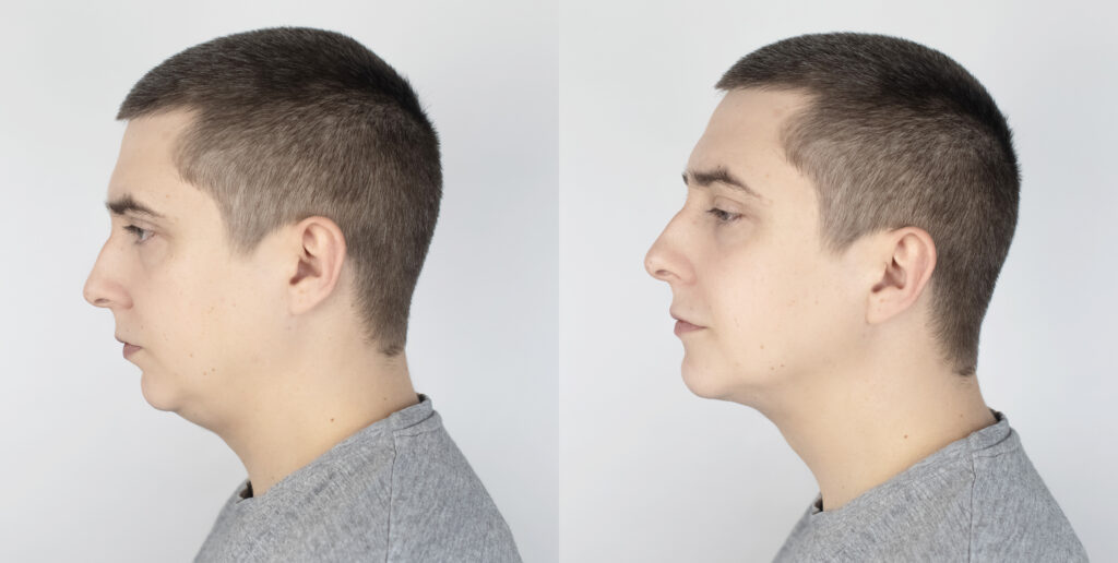 Male jawline before and after dermal filler treatment