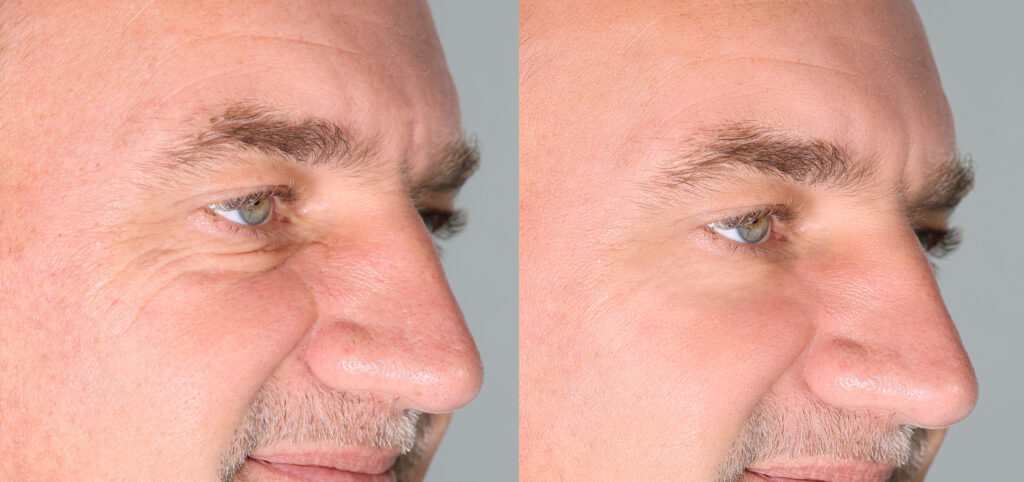 Dermal fillers before and after results for wrinkle reduction in a mature man.