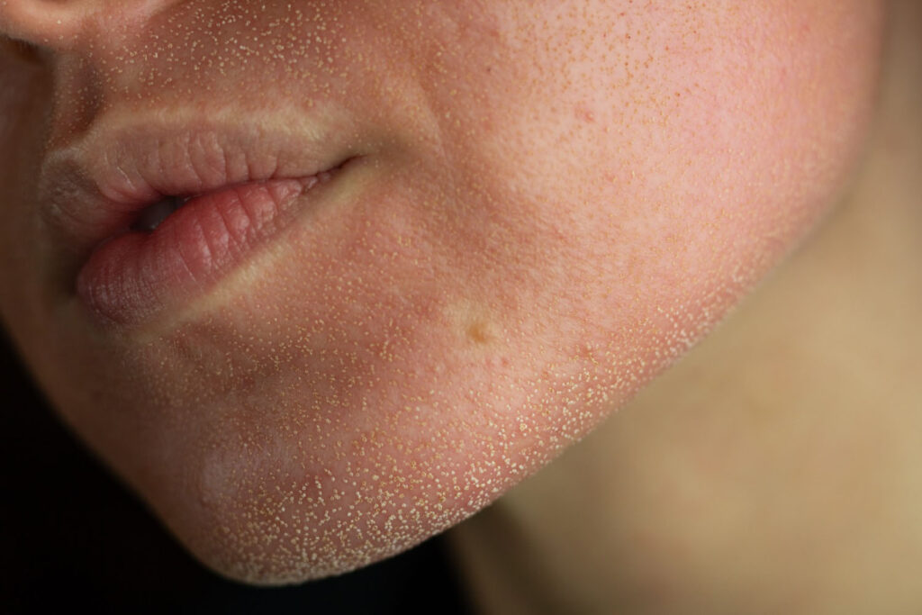 side-by-side close-up of a cheek showing redness and small blemishes on the left and smoother skin on the right