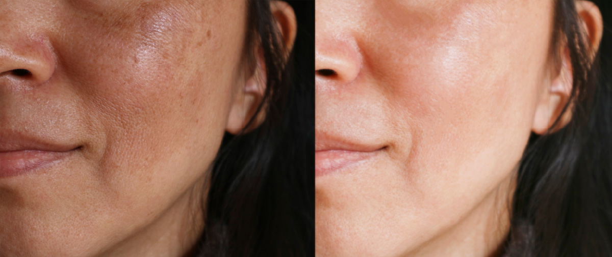 Side-by-side close-ups of a person’s cheek showing two different skin appearances.