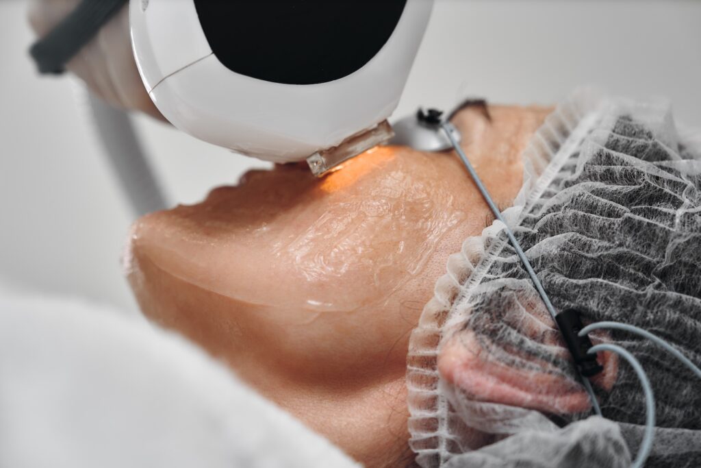 person receiving an IPL treatment with gel applied to their jawline and protective eye covering in place