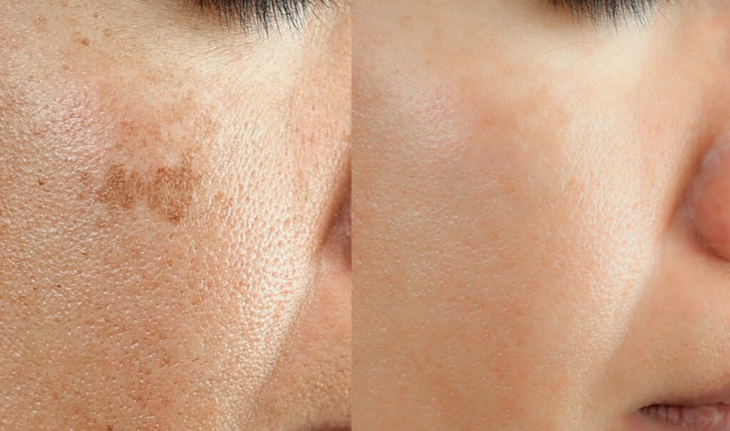 side-by-side close-up of a cheek showing dark pigmentation on the left and clearer skin on the right