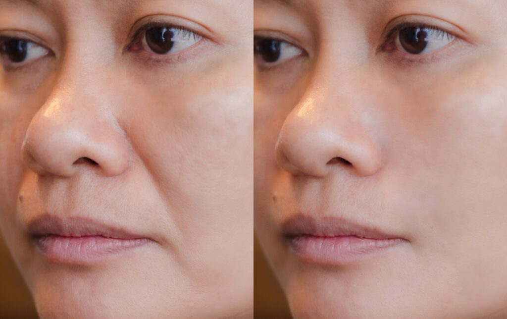 Two close-up views of the same woman’s cheek, nose, and mouth area shown side by side.