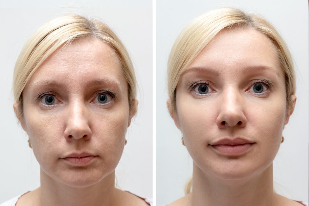 Side-by-side front-facing images of the same woman showing her face before and after a cosmetic treatment.
