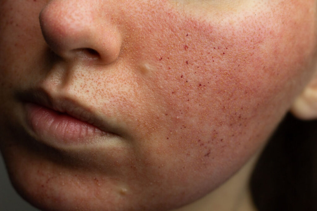 close-up of a cheek showing redness, small dark spots, and textured skin during post-treatment healing