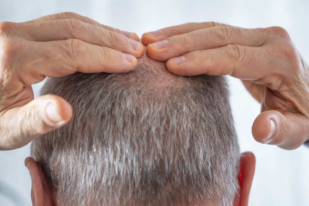 hands placed on the crown of a head, parting short gray hair to reveal the scalp