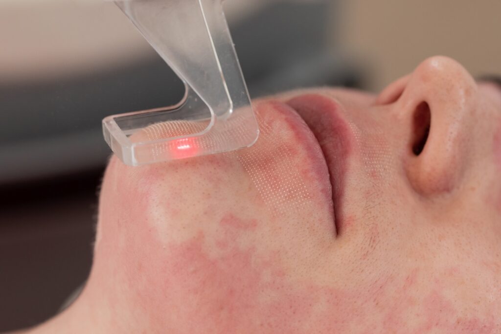close-up of a laser handpiece touching the skin above a person’s upper lip