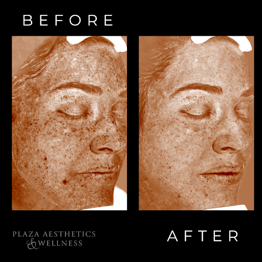 Side-by-side images labeled before and after showing a close-up view of facial skin texture.