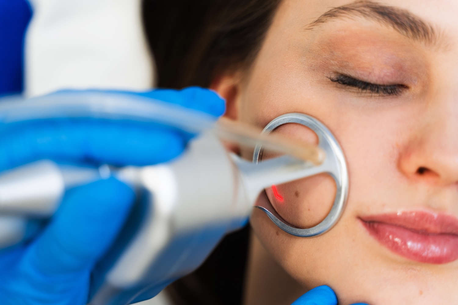 A handheld laser device with a circular tip is applied to a woman’s cheek while she lies back with eyes closed.