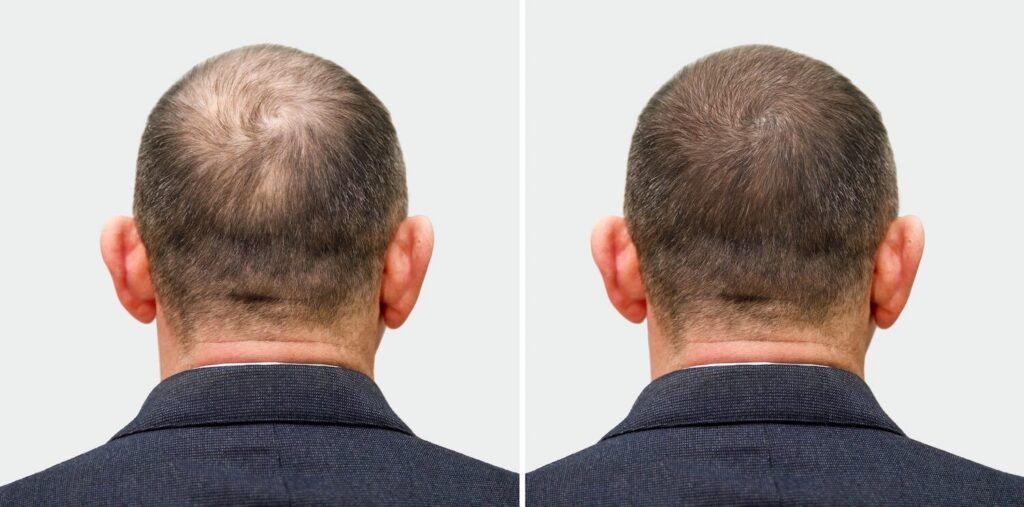 back view of man showing crown hair thinning comparison before and after treatment