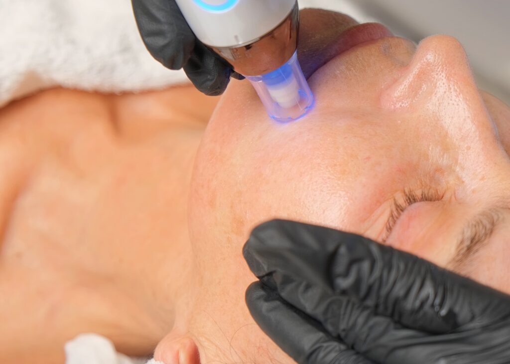 close-up of gloved hands holding a laser device against a person’s cheek during a skin treatment