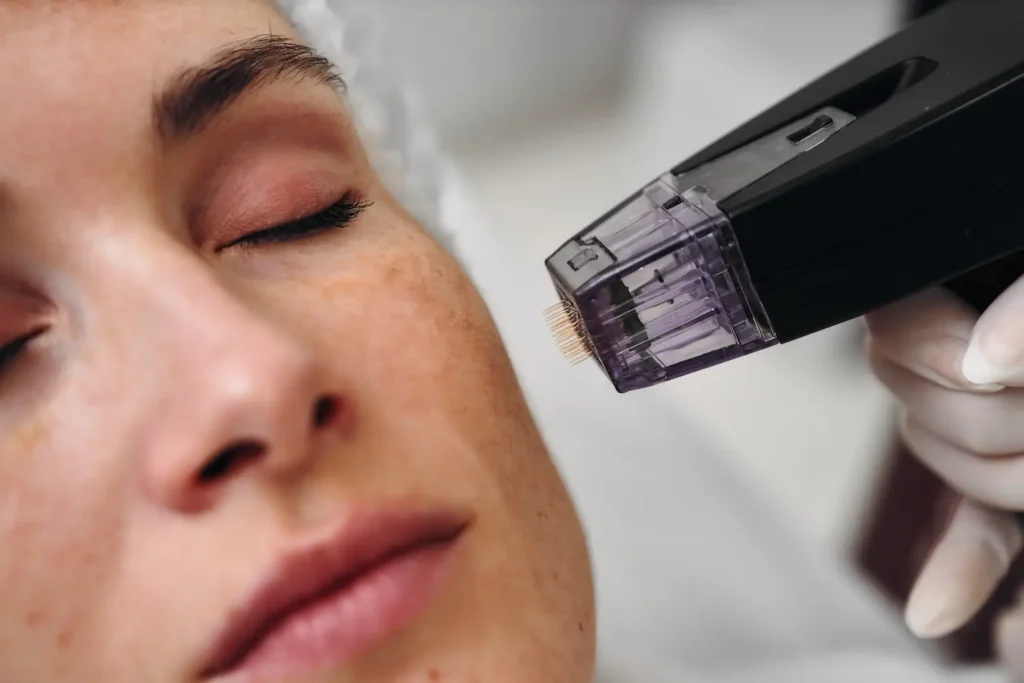 Close-up of a microneedling device with fine needles positioned near a person’s cheek as they lie back with eyes closed