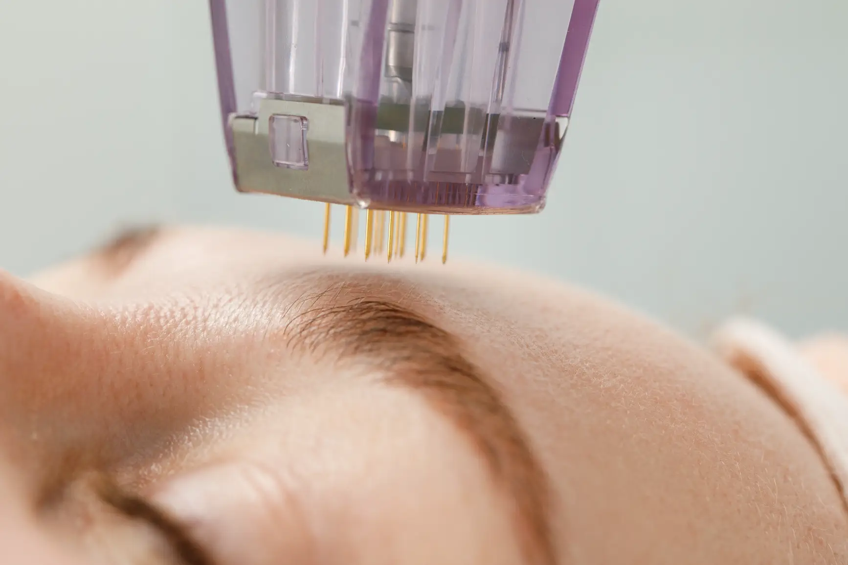 Microneedling device with fine needles applied to a person’s facial skin