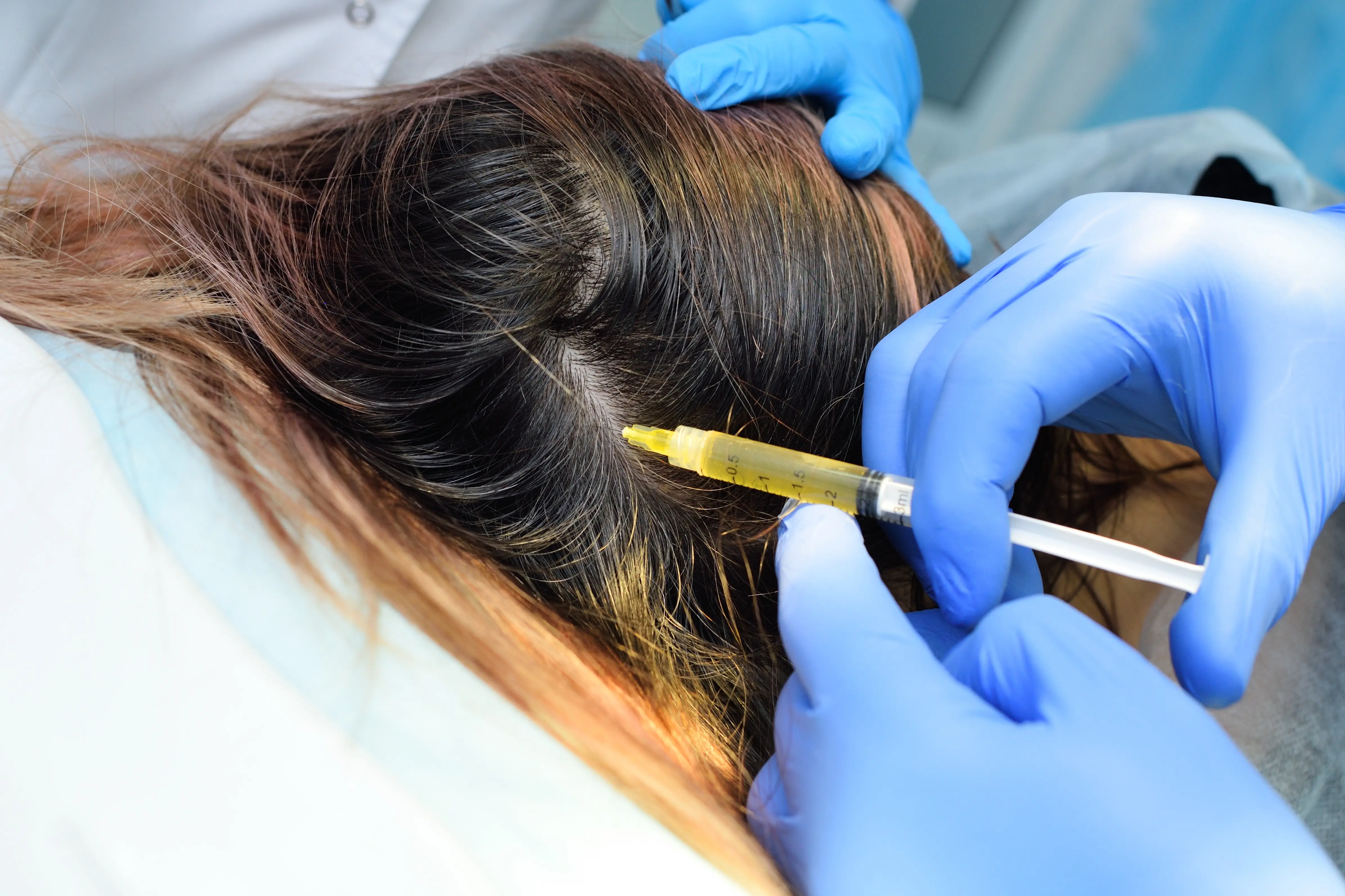 Gloved hands administering scalp injection for hair restoration treatment