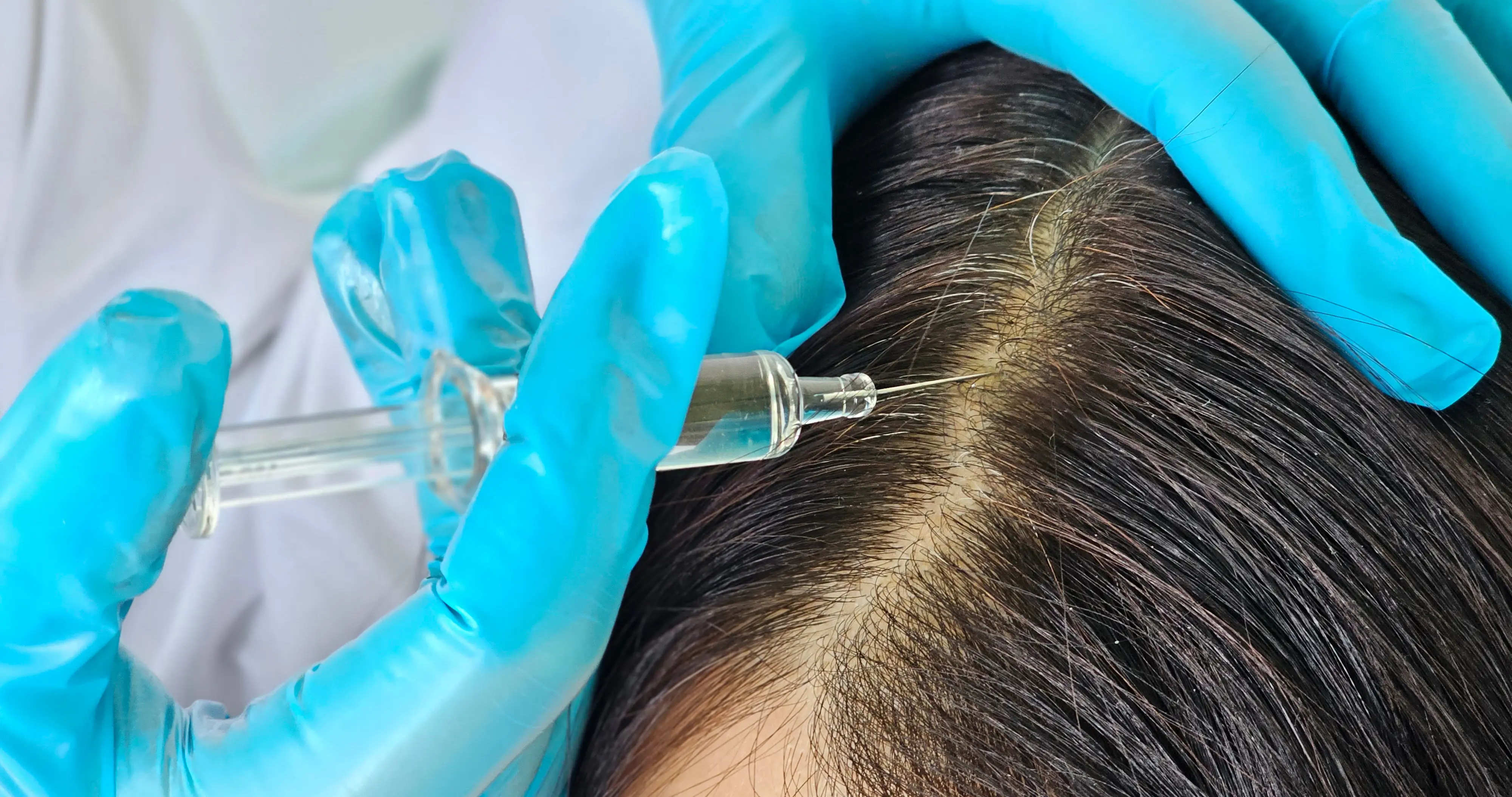 Injection being administered into scalp with visible thinning hair area