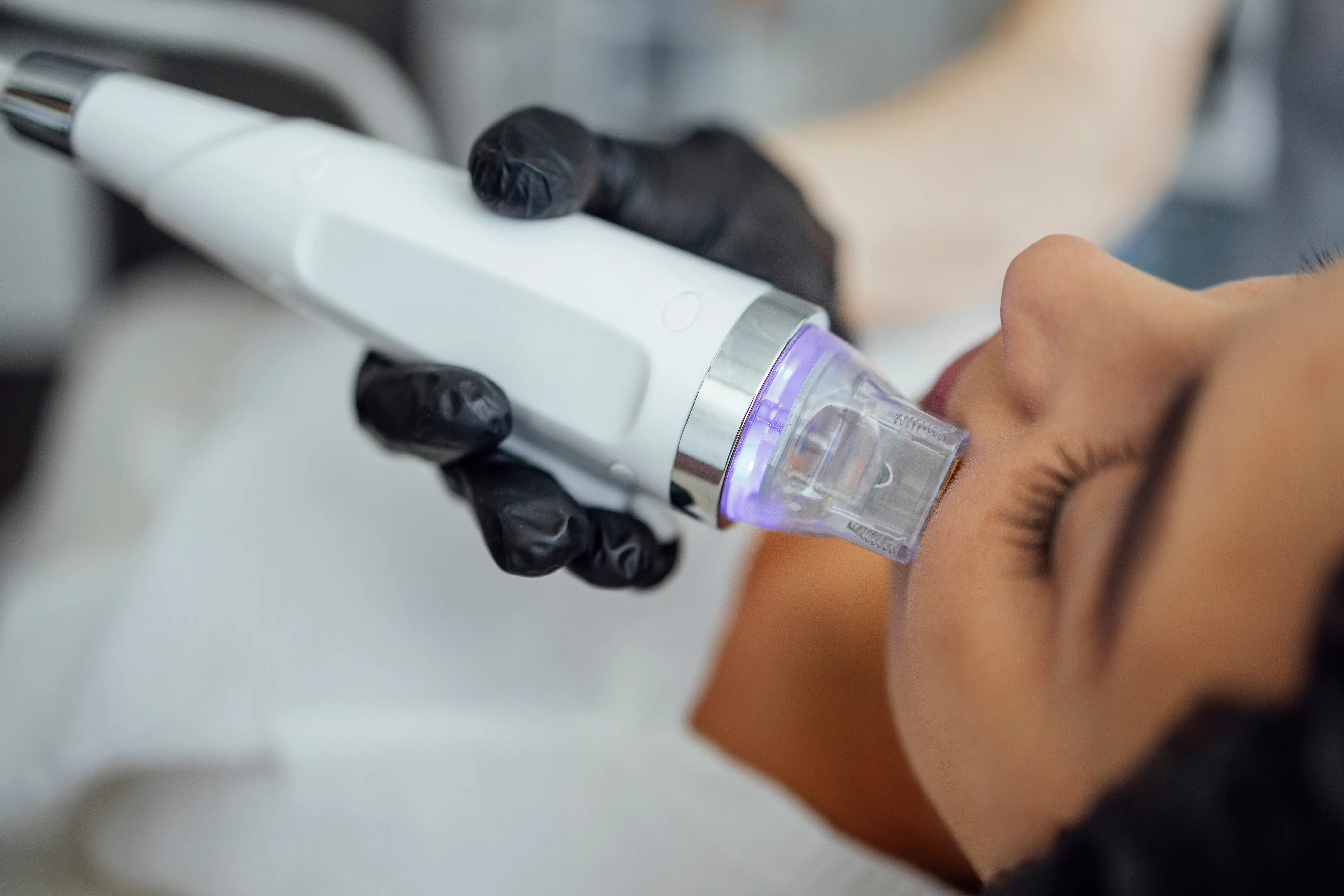 Clinician using a Morpheus8-style RF microneedling device on a patient's cheek during treatment